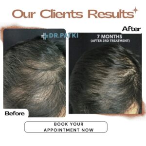 Best Hair PRP | Hair Transplant Clinic in Surat,Hair Transplant in Surat, Best Hair Transplant Surgeon Surat, Hair Restoration Surat, Top Hair Transplant Clinic Surat, Hair Transplant Surgeon Dr. Surbhi Patki, Hair Transplant Treatment Surat, Anti Hairfall treatment in surat, Affordable Hair Transplant Surat, Advanced Hair Restoration Surat, Hair Loss Treatment Surat, FUE Hair Transplant Surat, PRP Hair Treatment Surat, Best Hair PRP & Hair Transplant Clinic in Surat | Dr.patki