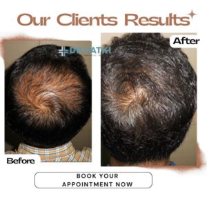 Best Hair PRP | Hair Transplant Clinic in Surat,Hair Transplant in Surat, Best Hair Transplant Surgeon Surat, Hair Restoration Surat, Top Hair Transplant Clinic Surat, Hair Transplant Surgeon Dr. Surbhi Patki, Hair Transplant Treatment Surat, Anti Hairfall treatment in surat, Affordable Hair Transplant Surat, Advanced Hair Restoration Surat, Hair Loss Treatment Surat, FUE Hair Transplant Surat, PRP Hair Treatment Surat, Best Hair PRP & Hair Transplant Clinic in Surat | Dr.patki