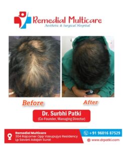 Best Hair PRP | Hair Transplant Clinic in Surat, Best Hair Transplant Surgeon in Surat