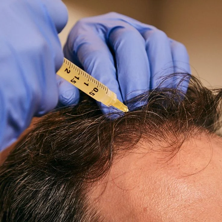 PRP for Hair Loss