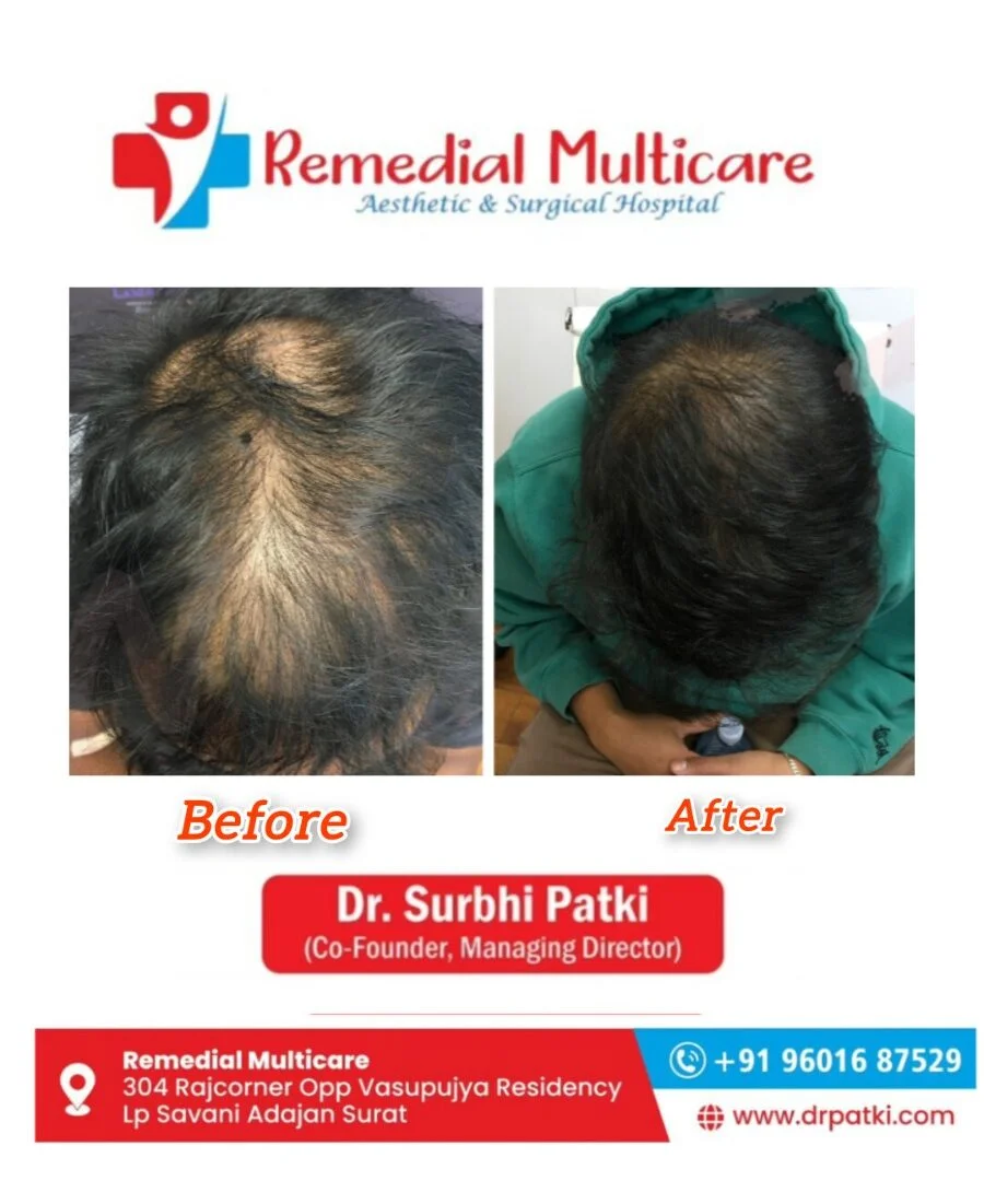 Hair Transplant in Surat: Cost, Safety, Recovery Time, and Side Effects